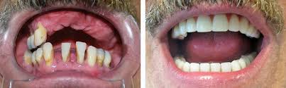 имплантация верхних зубов у мужчины 56 лет